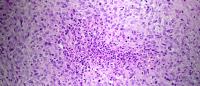 Pathology study of an epitheliod sarcoma of the hand